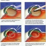 CataractSurgery