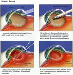 CataractSurgery